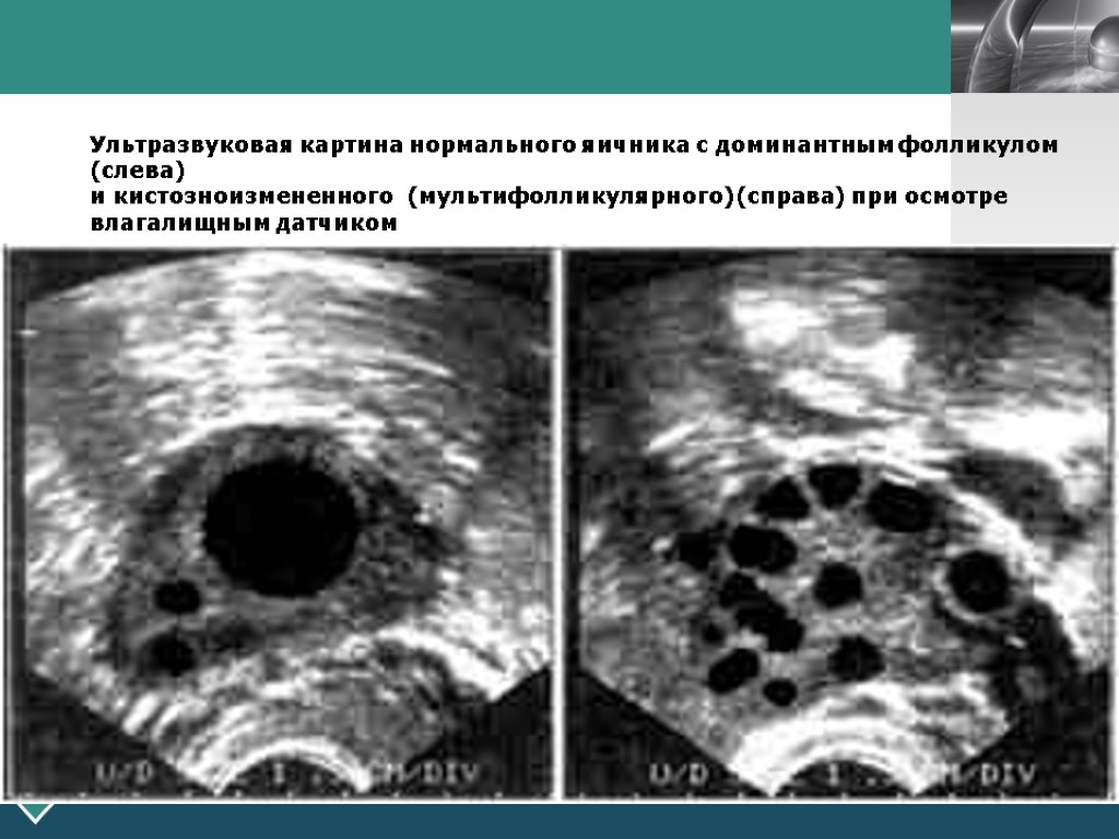 Ультразвуковая картина нормального яичника с доминантным фолликулом (слева) и кистозноизмененного (мультифолликулярного)(справа) при осмотре влагалищным